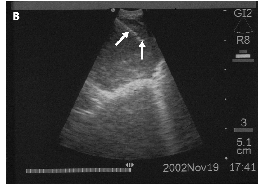 Provtagning med stöd av endobronkiellt/esofagalt ultraljud (EBUS/EUS) Diagnostik