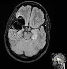Figur 2. Resektion av astrocytom grad 2 frontalt vänster. Postoperativ bild. Figur 3. Låggradigt gliom frontotemporalt höger (insula). Preoperativ bild. Figur 4.