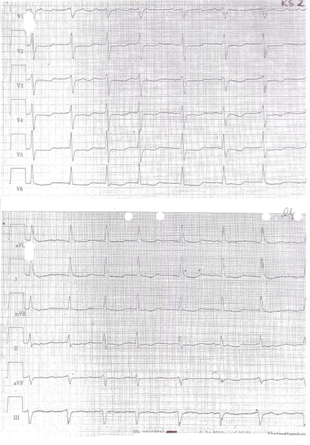 5 EKG KS2