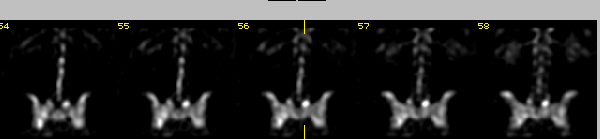 Bone SPECT Michael Ljungberg/Medical Radiation