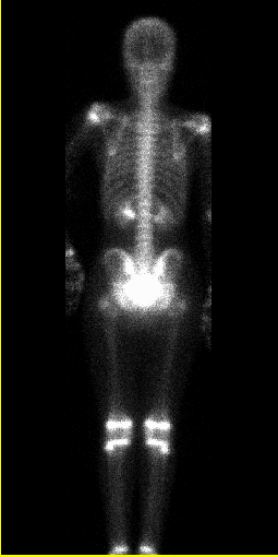 In vivo diagnostik Statisk studie: Bilder tas med gammakamera över undersökt organ vid en viss optimal tid efter administreringen av radiofarmakat.