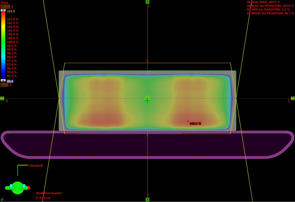 Metod Förberedelser Dosplanering: Standardplan Homogendos i vatten (32x32x10 cm 3 ) Energi: 6 MV AP- och