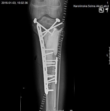 Resultat och diskussion Patient 2 Osteosarkom i vänster tibia Status oktober 2016 (ca 9 månader post op) Klar med cellgiftsbehandling Svår infektion pga operationen Det bestrålade benet