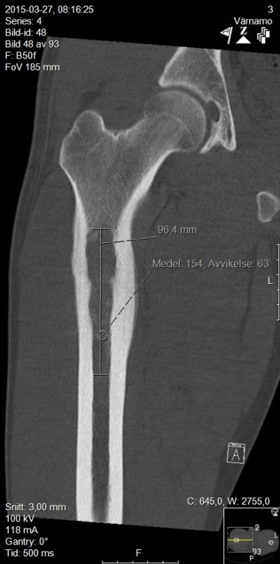 Resultat och diskussion Patient 1 Ewings sarkom i höger femur Status oktober 2016 (ca 10 månader post op) Komplett läkning Har kunnat gå med