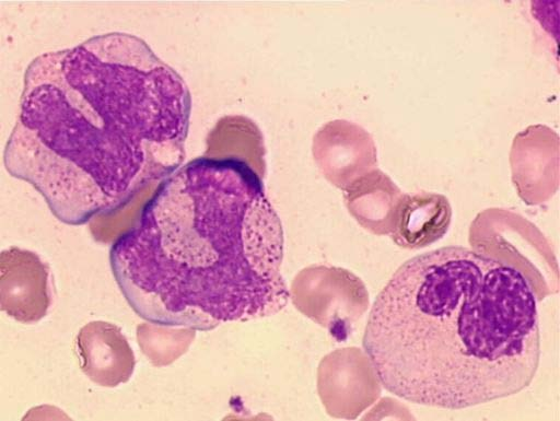 t(8;21)(q22;q22) - AML M2 RUNX1/CBFA2T1 Methods G-banding FISH