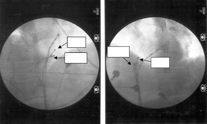 effektiv terapi. Inga komplikationer med allvarliga sequelae inträffade. En patient fick tamponad, som behandlades med sedvanligt perikarddrän, och vårdtiden förlängdes ett par dygn.