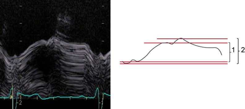 Sida 4 av 8 3 Figur 3. Tre varianter av AV-plansmätning. 1 = systolisk ejektionsamplitud (grön pil), 2 = total amplitud (röd pil), 3 = systolisk amplitud inklusive IVCT (blå pil).