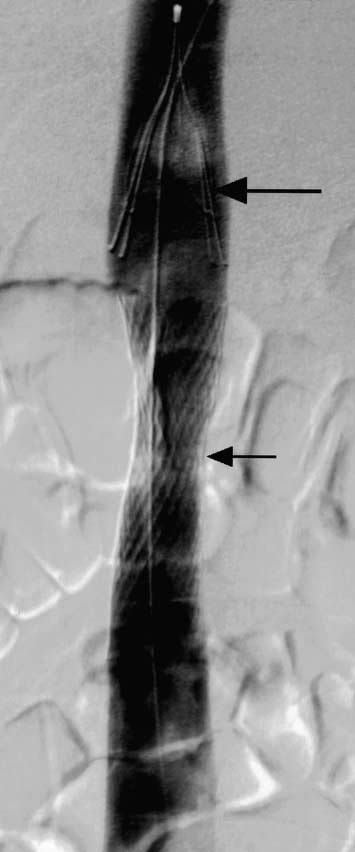 Figur 1. Kavografi efter inläggning av permanent LGM-filter (vid pilen) i vena cava inferior. Figur 2.