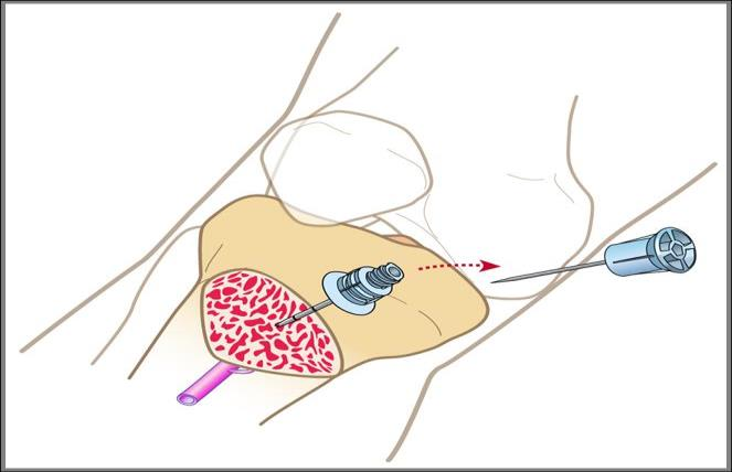 Instruktion Informera vaken patient om att injektion/infusion kan vara smärtsam. Palpera ut insticksstället (se bilaga 2) och desinficera. 2(8) Vakna barn ska alltid ha smärtlindring.