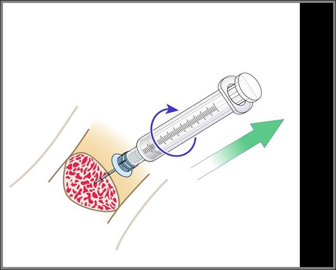 4(8) Borttagning av nålen Lossa medföljande infusionsslang från infarten. Använd spruta med luer-lock fattning eller en trevägskran och fäst denna på nålen (använd aldrig peang eller motsvarande).