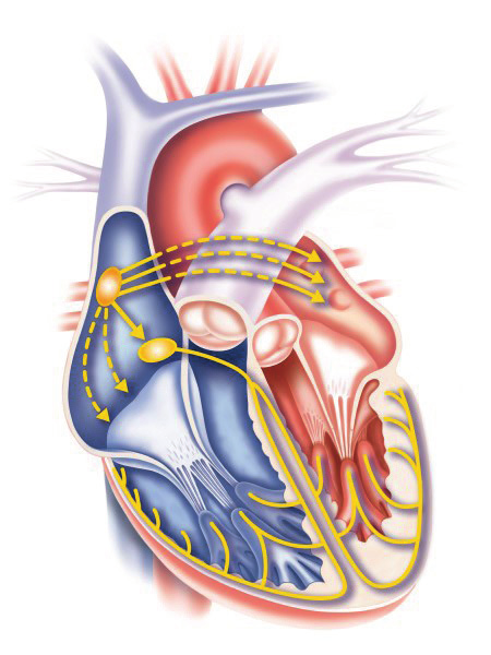 förmaksflimmer. Elektriska impulser överleds sedan via retledningssystemet till hjärtats kamrar på ett helt oregelbundet sätt. Vid förmaksflimmer slår hjärtat snabbt och ojämnt.
