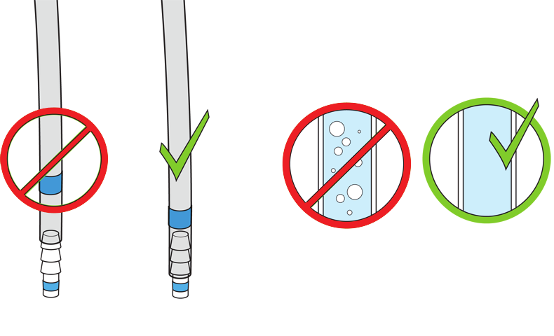 Steg 24 Installera silikonslangen i avluftningsventilen och anslut till vakuumkanistern Installera silikonslangen för bärargas, som kommer från Hemolung-behållaren, i avluftningsventilen genom att