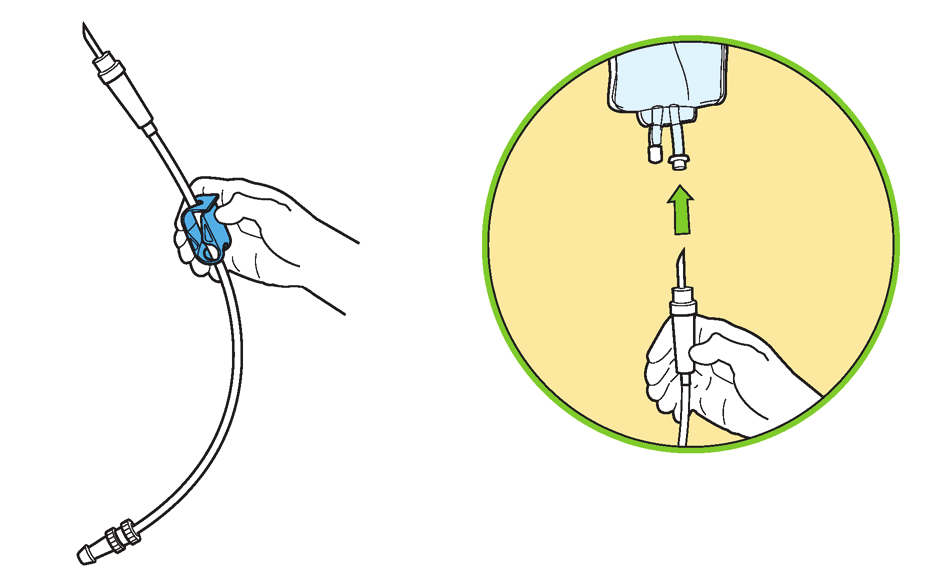 6 Avvänjning och Avsluta terapi Avvänjning från terapi görs genom att gradvis minska mängden CO 2 som elimineras medan patienten noggrant övervakas.