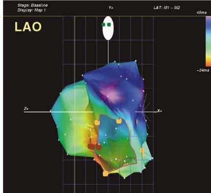 Klinik och vetenskap Figur 3. Elektroanatomisk kartläggning av arytmiursprung inom vänster förmak (fall 2). Den färgade strukturen representerar vänstra förmakets endokardiella omfång.