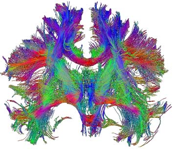 DTI (diffusion tensor imaging) DTI uses properties of the motion of water to look at tracts