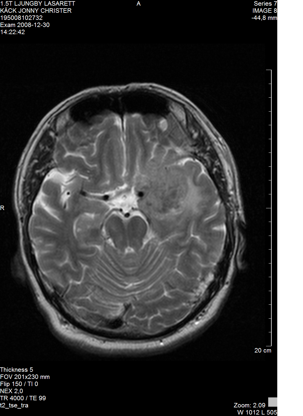 MR förstahandsval Akut (rygg) Trauma (medullapåverkan) Elektivt (skalle, thorax, buk, extremiteter) Hög / Specifik mjukdelskontrast (kontrastmedel) Epilepsi, levermetastaser, medulla Angiografi