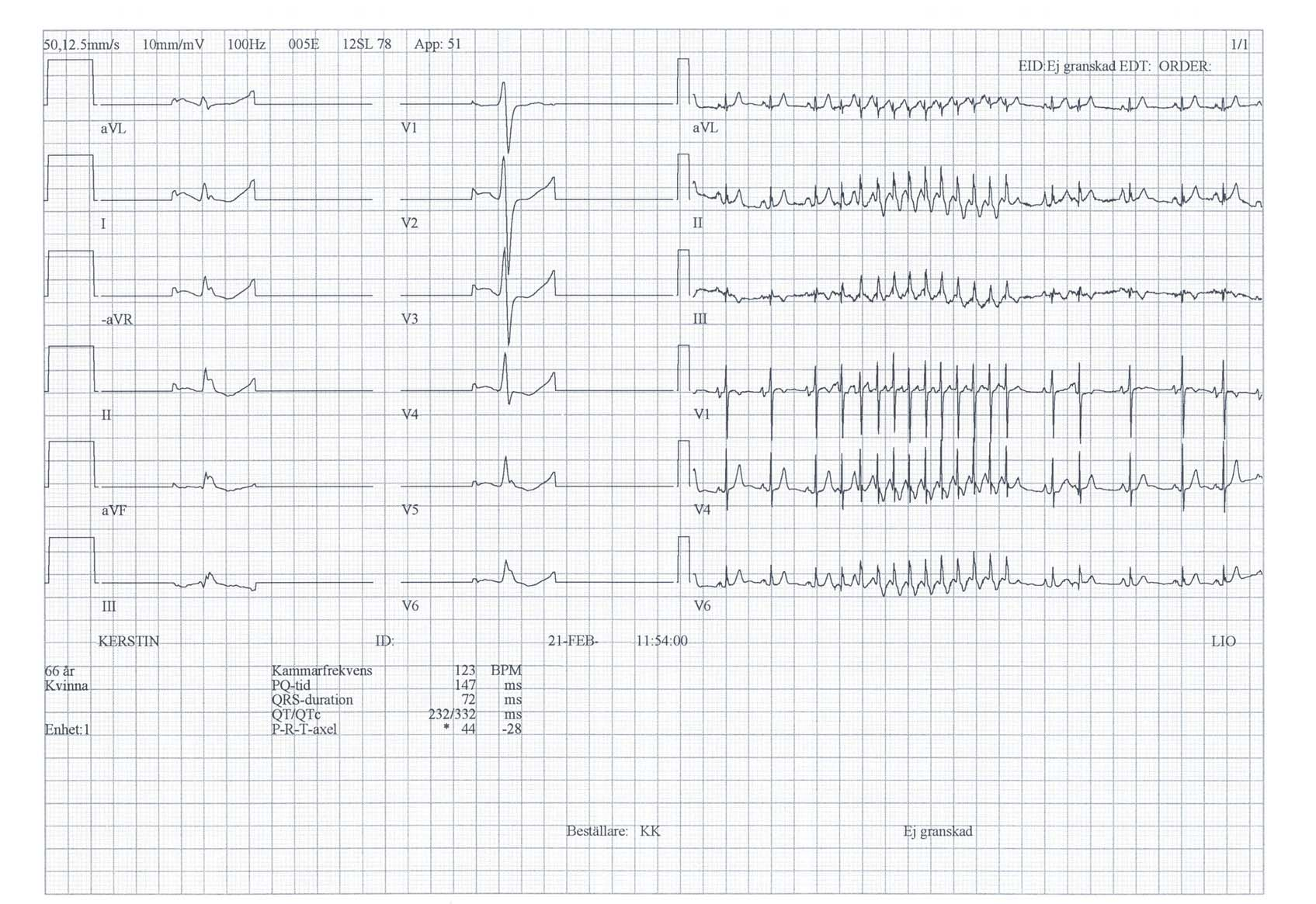 EKG 25