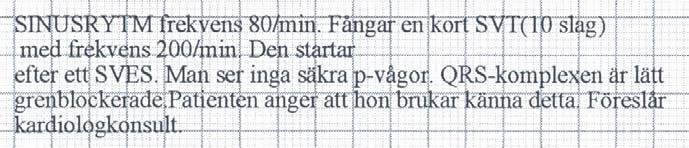 EKG 25 EKG nr 25 Svaret ändrades till följande lydelse innan svaret skickades: Kommentar P-vågor syns framför de vanliga slagen. Första P-vågen efter takykardi-episoden har annan form. Syns bra i V1.