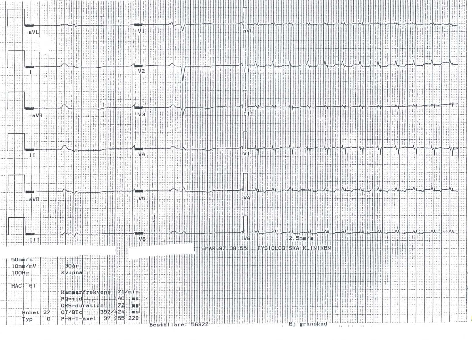 EKG 28 EKG nr 28 Överkurs P-vågor Höga och spetsiga P-vågor. Höger förmakshypertrofi.