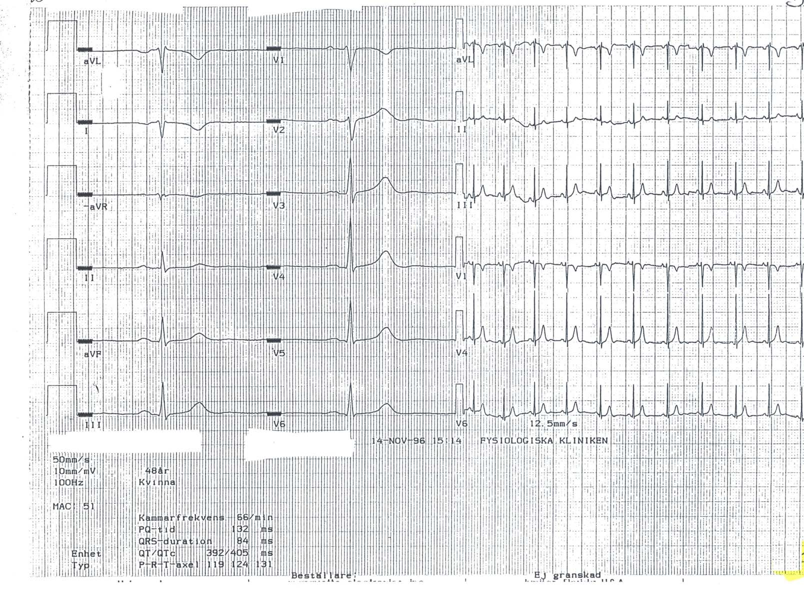 EKG 30 EKG nr 30 Sammanfattning Elaxel markerat högerställd. Neg T-vågor i avl, I och -avr Kommentar Är EKG:t rätt kopplat?