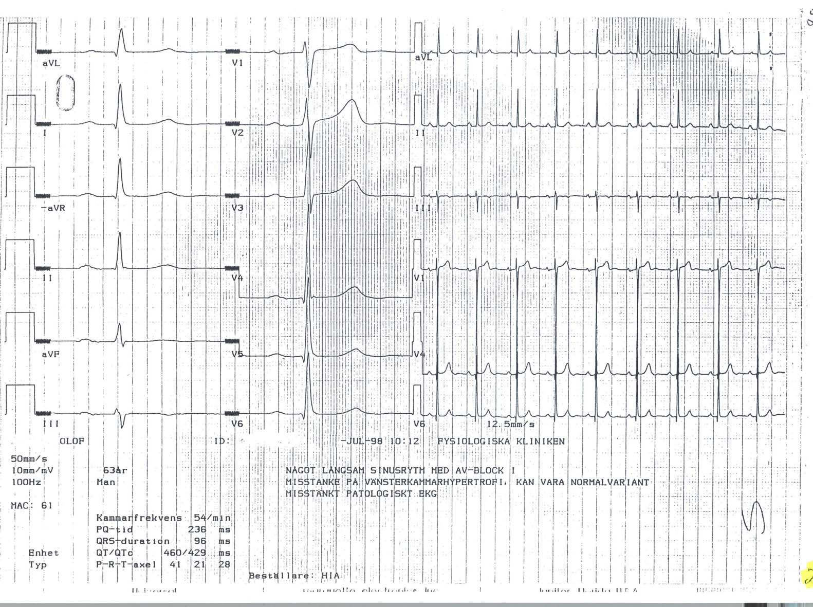 EKG 22 EKG nr 22 Sinusrytm med AV-block I och HR 54.