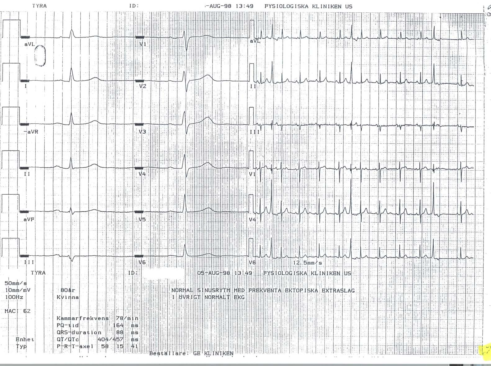 EKG 23 EKG nr 23 Sammanfattning Sinusrytm med HR 65-80. Frekventa lätt breddökade interpolerade extraslag, troligen VES.