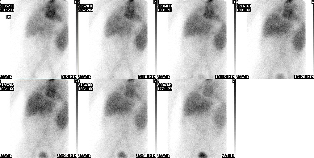 Scintigrafi av transplanterad lever med 99m