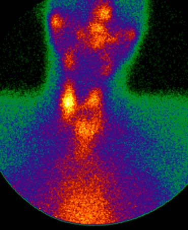 Thyroideascintigrafi Normal bild Graves sjukdom lingual het