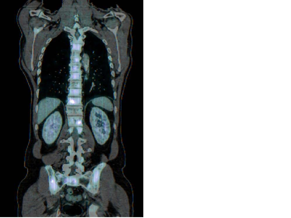 PET/CT Patient