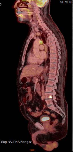 PET /CT på patienten med