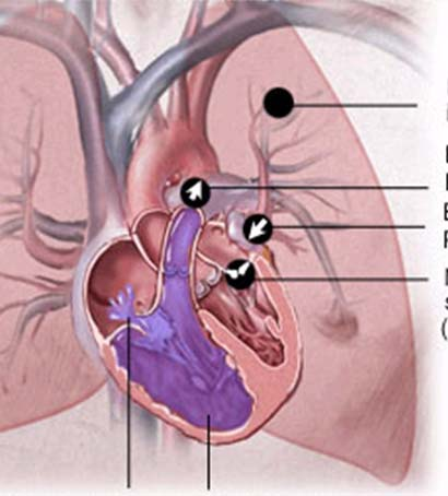 Pulmonell hypertension Vänsterhjärtsvikt är den vanligaste orsaken till PH > 25 mmhg