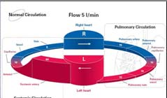 Högerkateterisering: normal PVR, vä-hö shunt 2:1 CO 5,3 L/Min