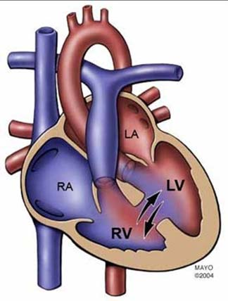 Eisenmenger: pulmonell hypertension med omvänd shunt När PVR ökar vänder shunten hö vänster VSD, PDA, ASD Högerkammarbelastning Cyanos