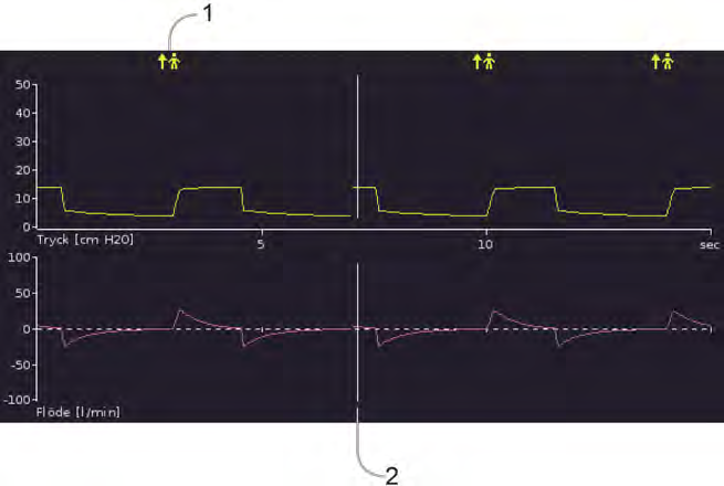 Använda Astral-enheten Vågformer Skärmen Vågformer visar de sista 15 sekunderna av patientens luftvägstryck och -flöde i ett diagram. Diagrammet uppdateras i realtid.