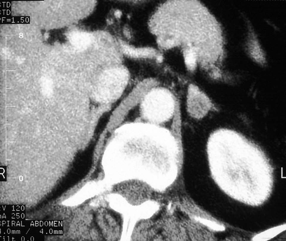 Adenoma