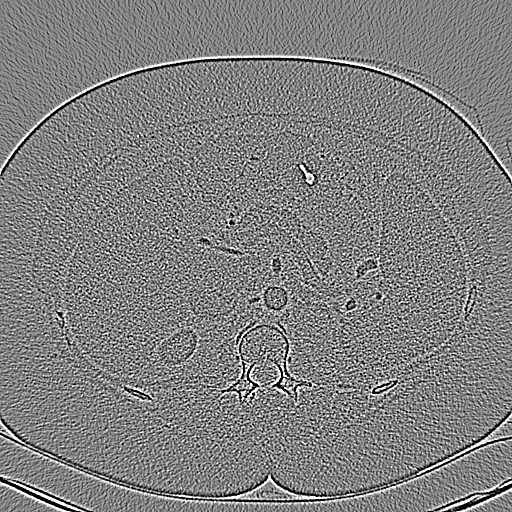 WFBP SAFIRE, 5 iterations WFBP, soft kernel