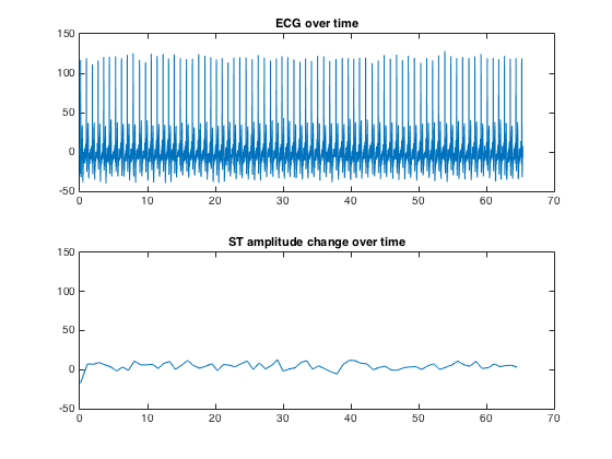 4.2 EKG 2 Resultatet från algoritmen visas i figur 5, vilket tyder på ett normalt EKG. Figur 6 visar att det ast är små ST-förändringar och ingen ST-höjning eller -sänkning.