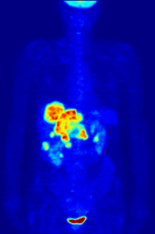 Whole-body cancer imaging with [ 18