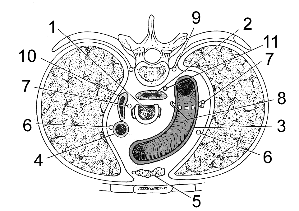 3. Bilden visar ett tvärsnitt av thorax i höjd med kota T4. Bilden visar tvärsnittet på samma sätt som ett skiktröntgen.