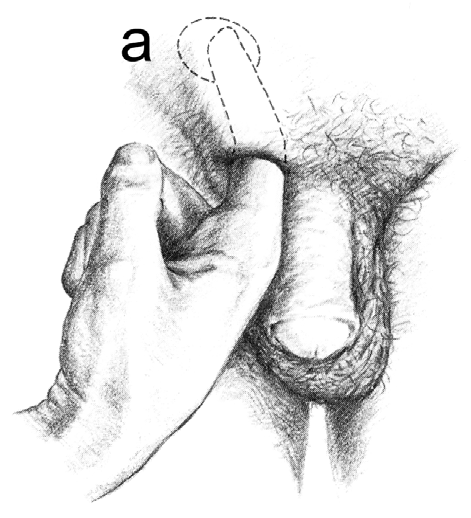 6. Vid en rutinundersökning av en manlig patient utför du följande moment: a. Vilken öppning (a) palperar du med pekfingret? (0,5 poäng) b.