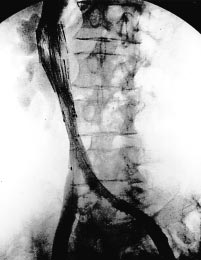 Patient med metastaserande prostatacancer. a. Kompression av bäckenkärlen och v cava av lymfkörtlar i buken; b.