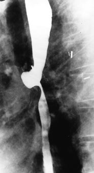 a Figur 4. Stentbehandling av malign esofagusstriktur. a. Striktur i mellersta esofagus sekundär till skivepitelcancer; b. Lumen återställd efter stentinläggning. sjukdomstillstånd.