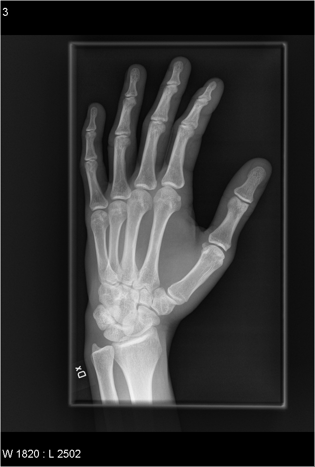 HAND - utåtvridning Kriterier Hela handen och distala delarna (ca 2,5cm) av radius och ulna bör ses. mjukvävnader bör ses. Fingrarna bör vara separerade.