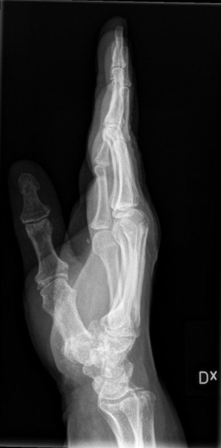 HAND sida Kriterier: Hela handen och distala delarna (ca 2,5cm) av radius och ulna bör ses. mjukvävnader bör ses.