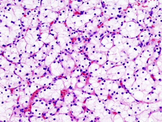 B3) Du arbetar som patolog och analyserar en njurtumör. I mikroskopet ses ovanstående morfologi. a) Beskriv histologin. b) Vilken diagnos håller du som mest sannolik?