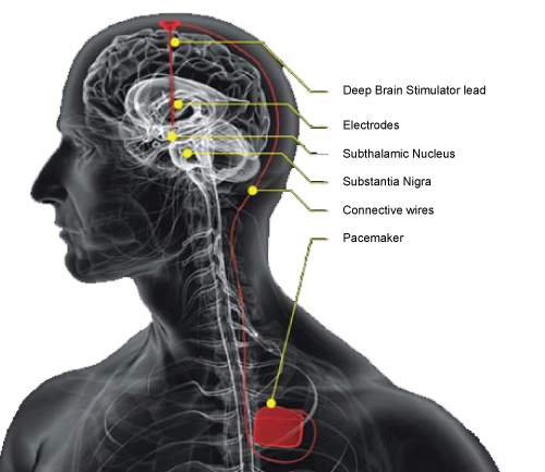 Djup hjärnstimulering (DBS) Figure: Djup hjärnstimulering vid Parkinsons sjukdom: Behandlingen går ut på att stimulera nervceller i ett visst område med elektriska impulser DBS-systemet: Elektrod i