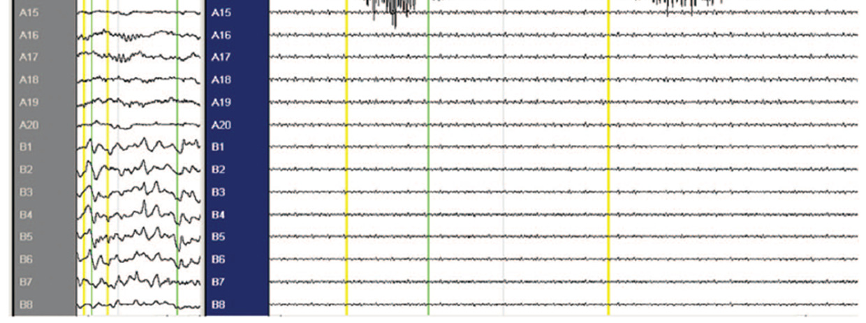 Med högre samplingsfrekvens och filtrering kan man se detta mönster på intrakraniella registreringar och EEG mönstret anses av många vara en markör