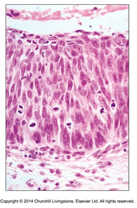Förekomst av kärnatypi i form av mörka, förstorade, pseudostratifierade cellkärnor 2. Förekomst av karryorhektiskt debris i det dysplastiska körtelepitelet 3.