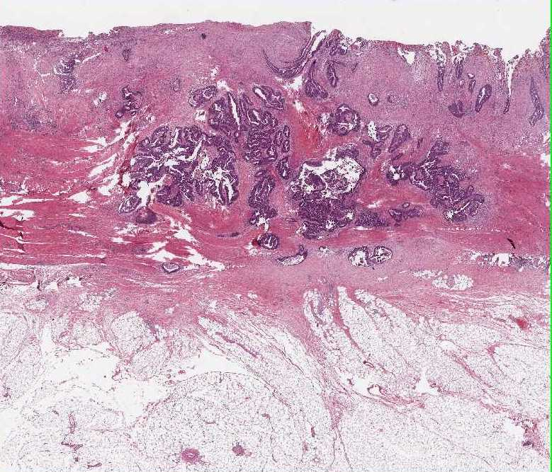 Kliniskt och lab mässigt tydliga tecken på inflammation samt ömhet i vänster fossa där en resistens anas.