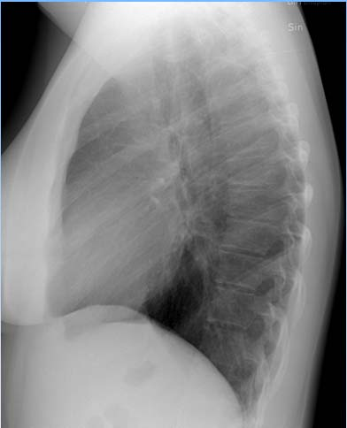 Främre mediastinum